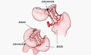 股骨头坏死