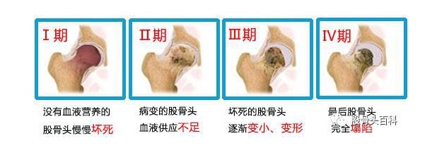 股骨头坏死不同时期